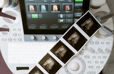 Ultrasound machine displaying 3D scans, with printed sonogram images adjoining.