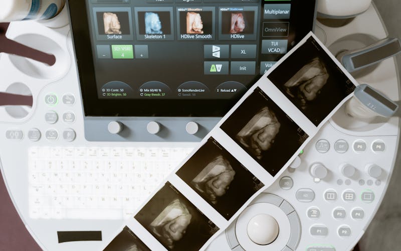 Ultrasound machine displaying 3D scans, with printed sonogram images adjoining.